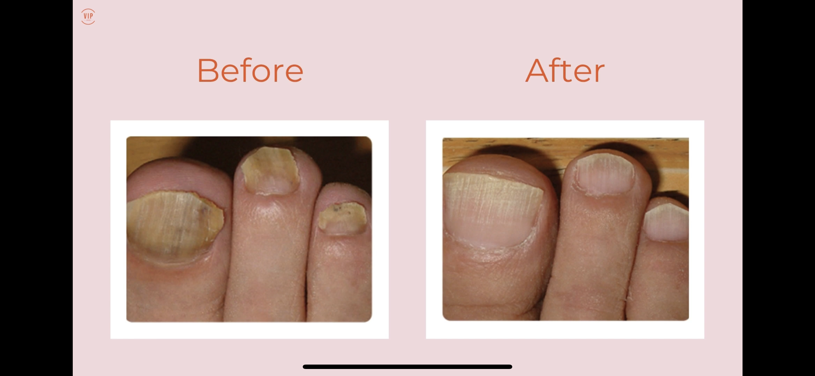 Nail fungus treatment in Hurghada |Book now| Nadara